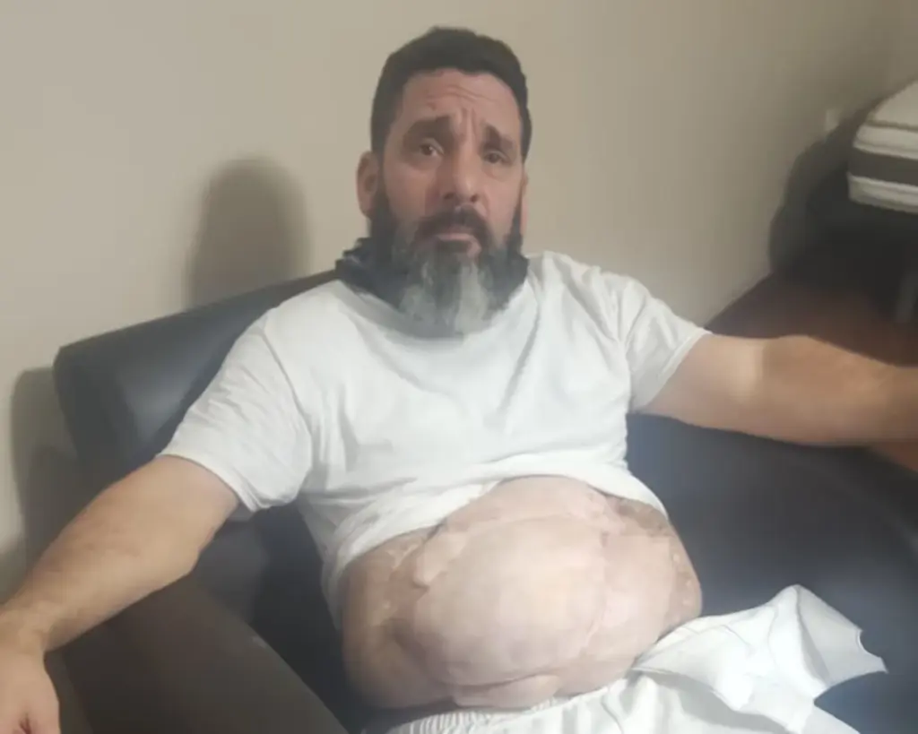 Leonardo Sánchez, Cuban deported to Liberia from the United States in serious health condition due to a ventral hernia. August 2026.