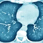 Transfer RNA, the same pioneering treatment for dozens of genetic diseases