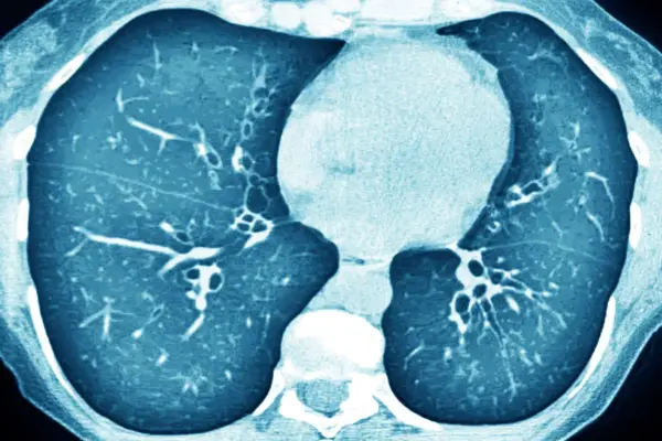 Transfer RNA, the same pioneering treatment for dozens of genetic diseases