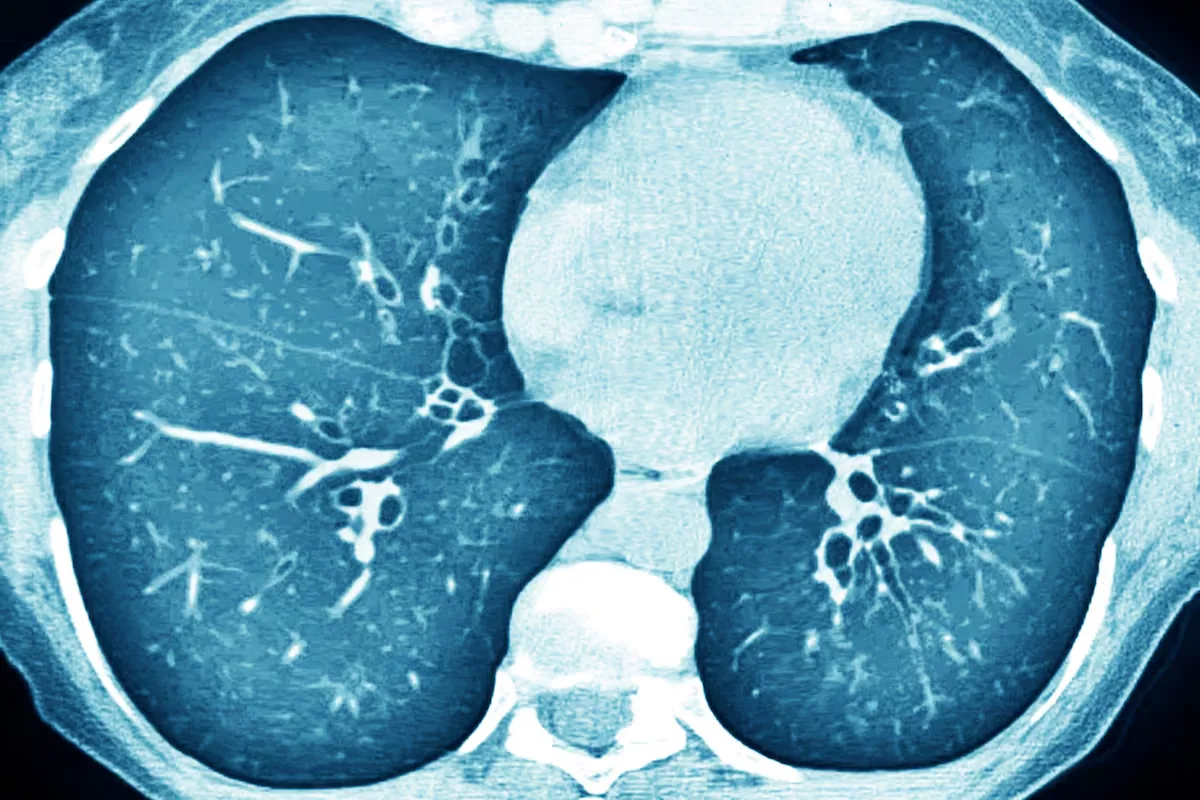Transfer RNA, the same pioneering treatment for dozens of genetic diseases