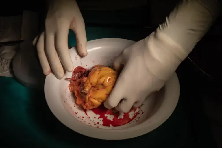 Conchita Barredo, four years after her heart transplant: “I am better than 20 years ago”