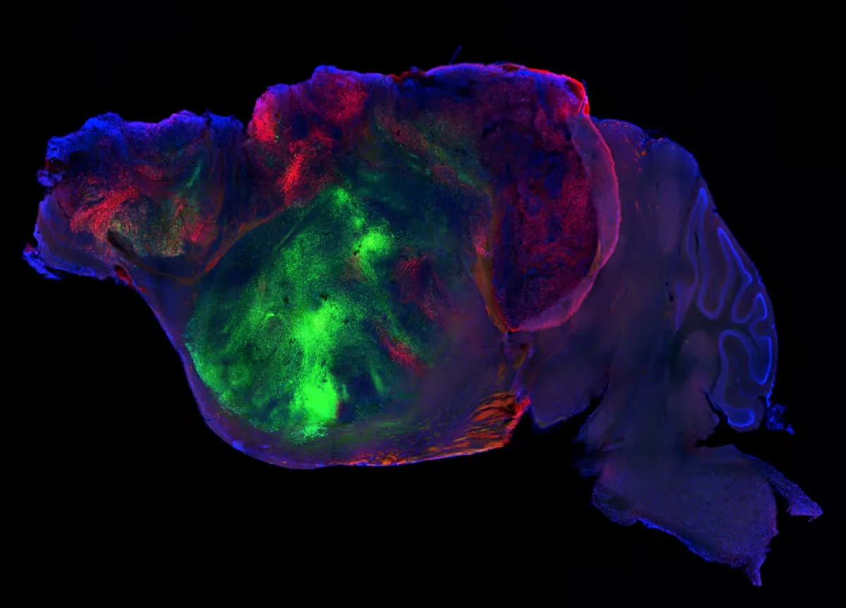Mice with millions of human neurons in their brains bring us closer to the answer to mental illnesses