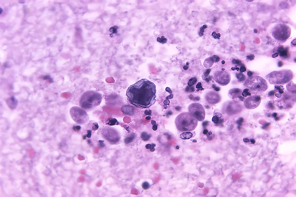 The 'brain-eating' amoeba leaves its first victim in Yucatán: a wakeboard instructor from an artificial lake
